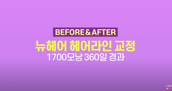 여자 이마 작아지는 헤어라인 교정 (모발이식) 1700모낭 1년 후 관련 이미지 1