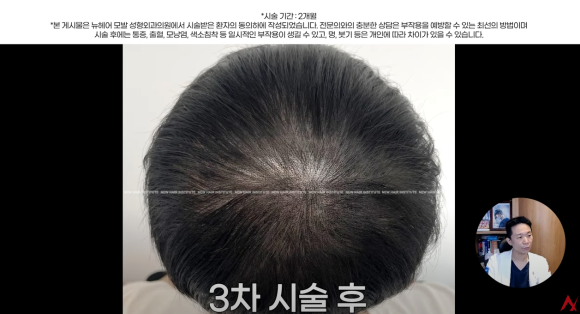 정수리탈모문신 시술직후 나타나는 효과?(전후사진) 관련 이미지 18