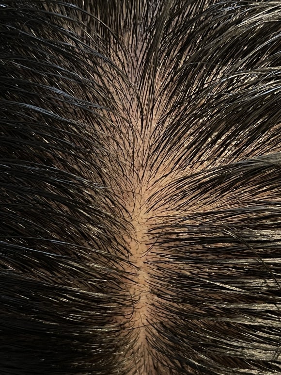 Hairline Scalp Micropigmentation: Procedures for a Natural Look image 4