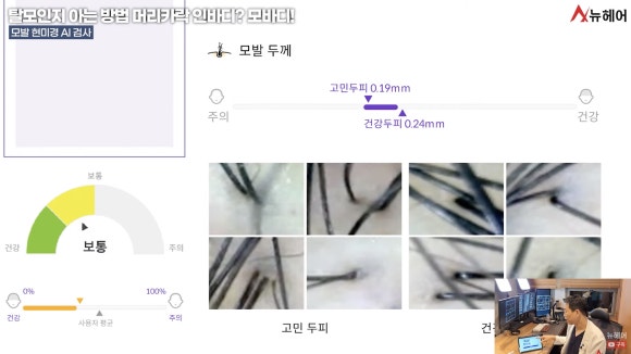 탈모진단병원, 관련 이미지 5