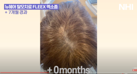 뉴헤어 탈모치료 모낭주사 7개월 전후 사진 관련 이미지 2