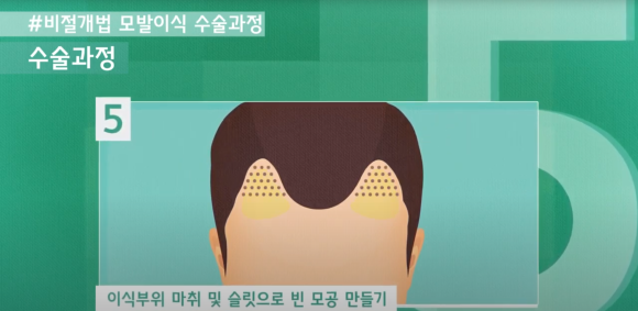 모발이식 수술 뉴헤어에서 알아보기(절개,비절개,헤어라인,모발이식방법,수술) 관련 이미지 13