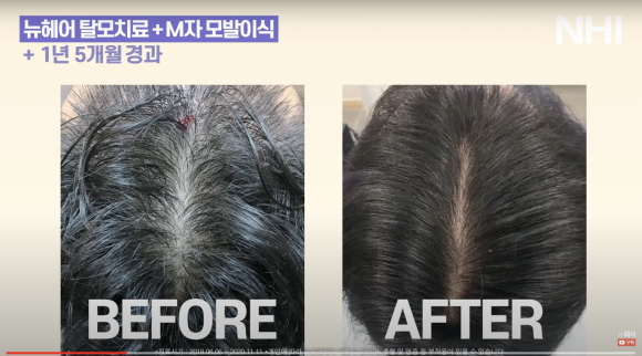 엑소좀 탈모치료 후기 (1년 5개월) 모발이식 + 탈모치료 관리 관련 이미지 1