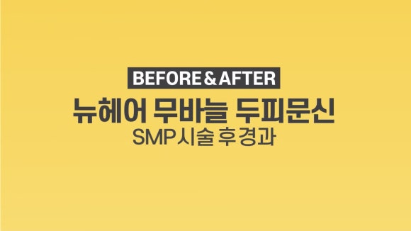 두피문신 전후사진 ㅣ뉴헤어 ㅣ 강남두피문신 관련 이미지 1