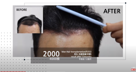 모발이식 1년 후기 빗질 영상 관련 이미지 3