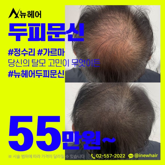 강남SMP 티나지않고 자연스럽게 두피문신 관련 이미지 3