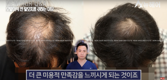 모발이식 알아봐야 한다면 관련 이미지 13