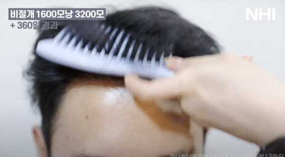 모발이식 비절개 1년 후기 전후사진 1600모낭 관련 이미지 5