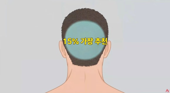 모발이식 재수술 FAQ : 밀도 부족·헤어라인·뻗침, 다시 심으면 해결될까요? 관련 이미지 3