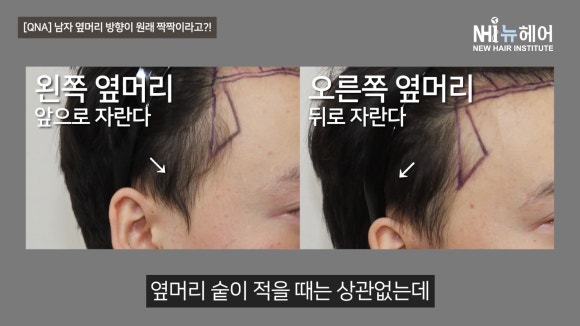 남자 옆머리 방향이 짝짝이일 때? l 모발이식하고 짝짝이가 된 머리, 이유 알려드립니다 관련 이미지 9