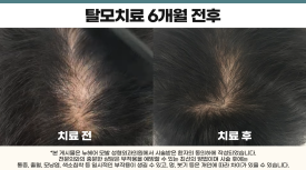 탈모주사치료 후 중단해도 될까? 효과는 유지될까? 관련 이미지 2