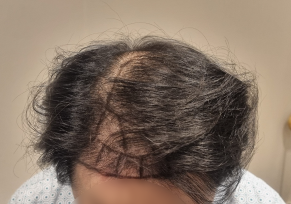 Hair Loss Treatment: Different Strategies by Area (When Combination Treatment Is Used) image 3