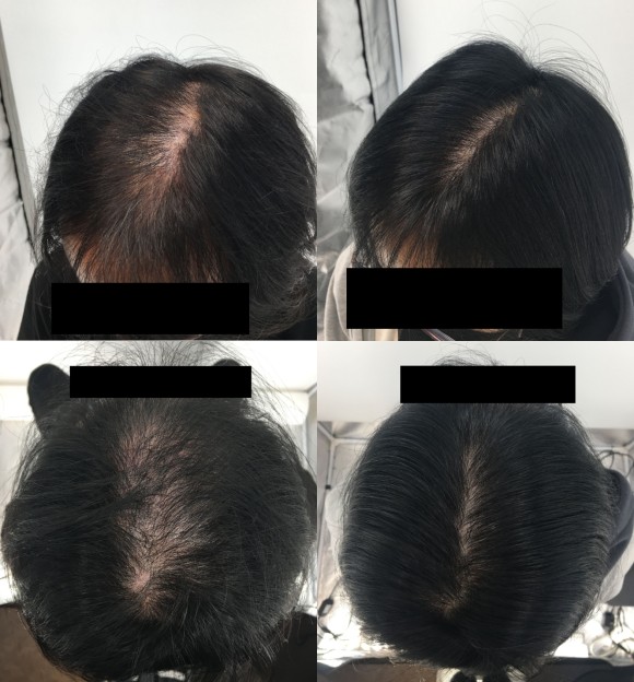 두타스테리드 변화? <의사작성> 관련 이미지 3