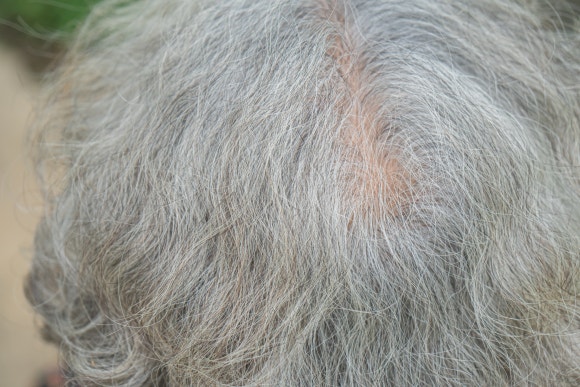 Postmenopausal Hair Loss: Why Do More Than Half of Women Experience It? image 2
