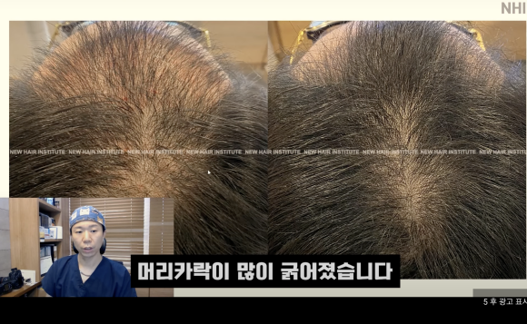 탈모치료 엑소좀, 엑소좀 뜻, 역할, 탈모 치료 효과ㅣ 정수리 탈모 ㅣ 전후사진 관련 이미지 17