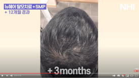 탈모치료(모낭주사) 1년 효과 l 뉴헤어 엑소좀 탈모치료 관련 이미지 4