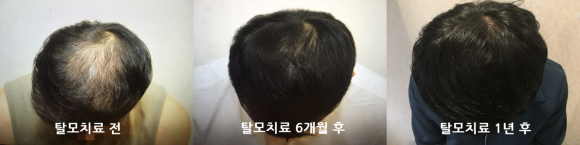 ※동일인주의※ 탈모치료(모낭주사) 1년 후 사진 관련 이미지 1