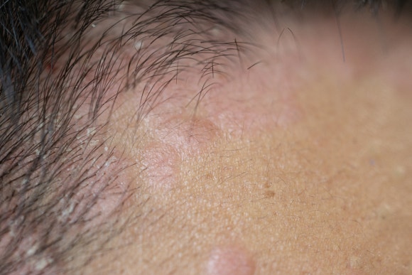 Why Does Winter Hair Loss Seem Worse When the Seasons Change? image 3
