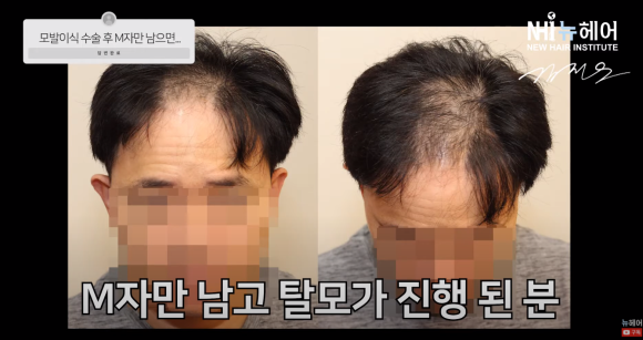 [뉴헤어] M자 엠자 모발이식 후 더듬이됐다? l  모발이식 후 탈모가 온다면... 관련 이미지 4