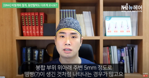 비절개 모발이식과 절개 모발이식, 동반탈락도 다르다? 관련 이미지 5