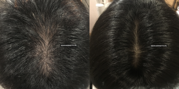 정수리 탈모 모낭주사 7개월 후 비교 사진 l 강남역 뉴헤어 관련 이미지 1