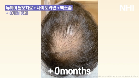 뉴헤어 탈모치료(모낭주사) 8개월 경과 사진 l 정수리탈모 관련 이미지 3