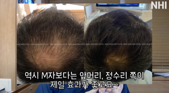엠자탈모 / 정수리탈모 / 여성탈모 각각 탈모치료법 소개, 탈모약 효과 관련 이미지 6
