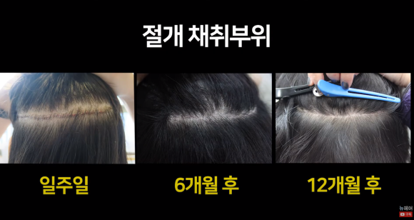 [뉴헤어] 모발이식 후 출근할 때 티 많이 나나요? ㅣ 회복 시간 관련 이미지 14