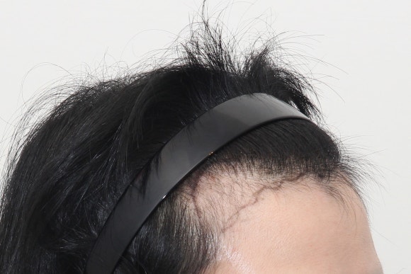 Female Hair Loss Types: It Can Happen Regardless of Age. image 1