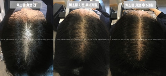 [탈모치료] 뉴헤어 탈모치료(엑소좀) 6개월 전후사진 관련 이미지 1
