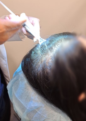 Autologous Cell Hair Loss Treatment, Treatment Using Autologous Follicle Cells image 4