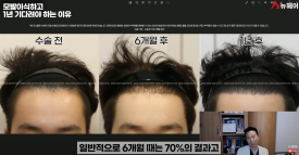 모발이식경과 1년을 기다려야 하는 이유 관련 이미지 8