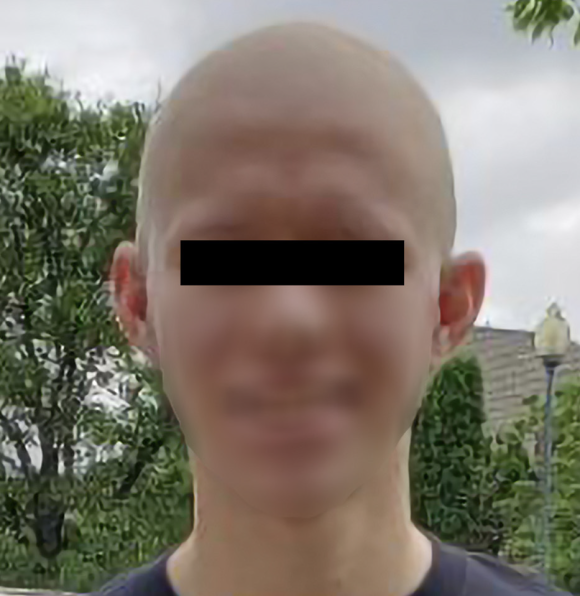 두필루맙, 원형 탈모 치료 사례 보고 관련 이미지 3