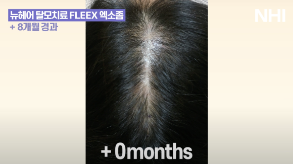가르마 탈모치료(모낭주사) 8개월 경과 후기 사진 l  탈모치료 관련 이미지 2