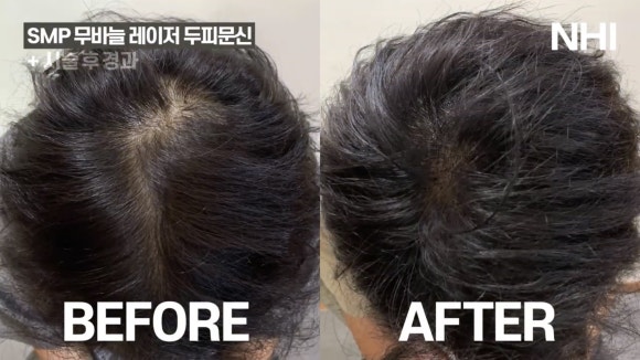 정수리 탈모 두피문신 전후 사진 / 영상 관련 이미지 2