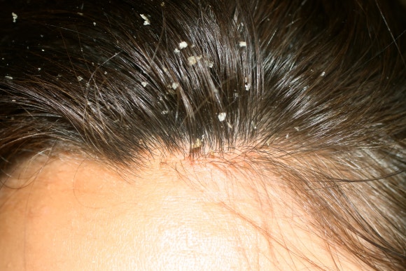 Could Dandruff Cause Hair Loss? Is That True? image 1