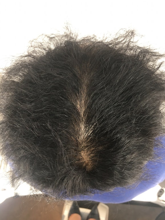 남성형 탈모 치료, 6개월 만에 이루어낸 변화 대공개 관련 이미지 2