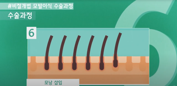 모발이식 수술 뉴헤어에서 알아보기(절개,비절개,헤어라인,모발이식방법,수술) 관련 이미지 14
