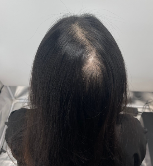SMP후기, 두피문신 받고 자신감 회복한 30대 여성분 사례 관련 이미지 5
