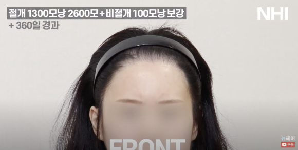 여자 모발이식 재수술 헤어라인교정 l  1300모낭 1년 경과 사진 l 3차 재수술 관련 이미지 2