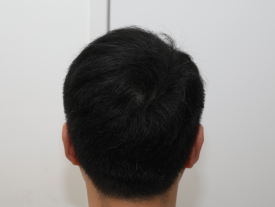 Why Are Crown Hair Transplants (Part-Line Hair Transplants) Slower to Show Results Than Other Areas? image 7
