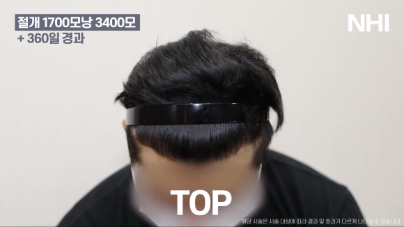 모발이식으로 엠자라인 벗어난 1년 후기 사진 l 1700모낭 이식 l 유전성탈모 관련 이미지 7