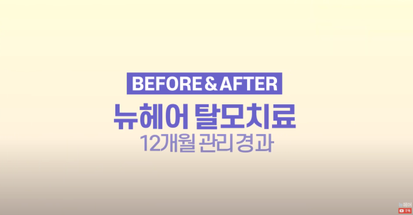 탈모치료(모낭주사) 1년 효과 l 뉴헤어 엑소좀 탈모치료 관련 이미지 1