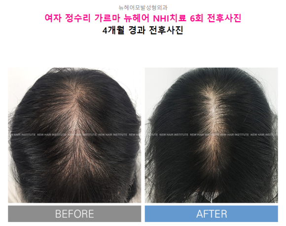 탈모약을 먹을까, 탈모시술을 받을까. 나에게 맞는 탈모 치료는? 관련 이미지 2