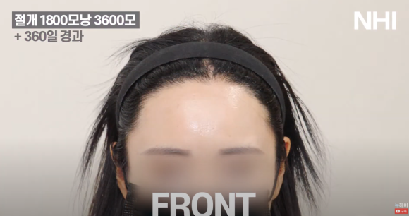 [뉴헤어] 여자 헤어라인교정 1800모낭 360일 이식 후기 관련 이미지 2