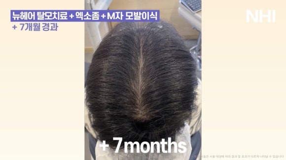 정수리탈모 엑소좀관리 7개월 경과 전후사진 관련 이미지 5