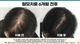탈모주사치료 후 중단해도 될까? 효과는 유지될까? 관련 이미지 5