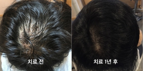 [탈모치료] 탈모주사(모낭주사) 1년 후 사진 비교 관련 이미지 1