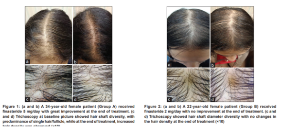Comparing the Effects of Oral Finasteride and Topical Minoxidil in Female Hair Loss image 4