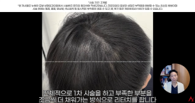 정수리탈모문신 시술직후 나타나는 효과?(전후사진) 관련 이미지 13